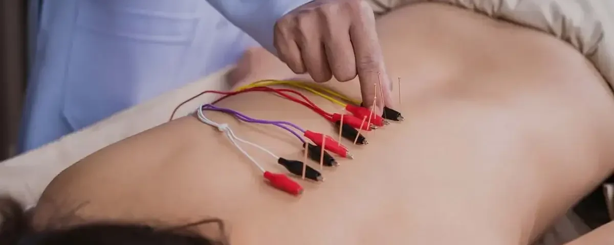 Acupuntura clínica 6 Fisio Invasiva acupuntura clinica optimizado