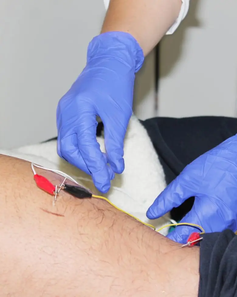 Punción seca 7 Fisio Invasiva ajustado acupuntura clinica