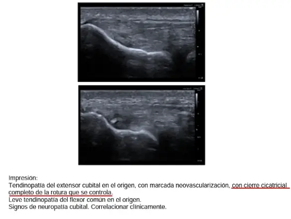 Resolución de casos complejos 10 Fisio Invasiva imagen tendon nueva