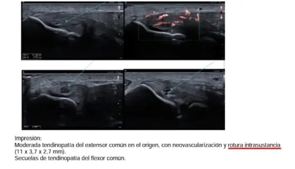 Resolución de casos complejos 8 Fisio Invasiva imagen tendon